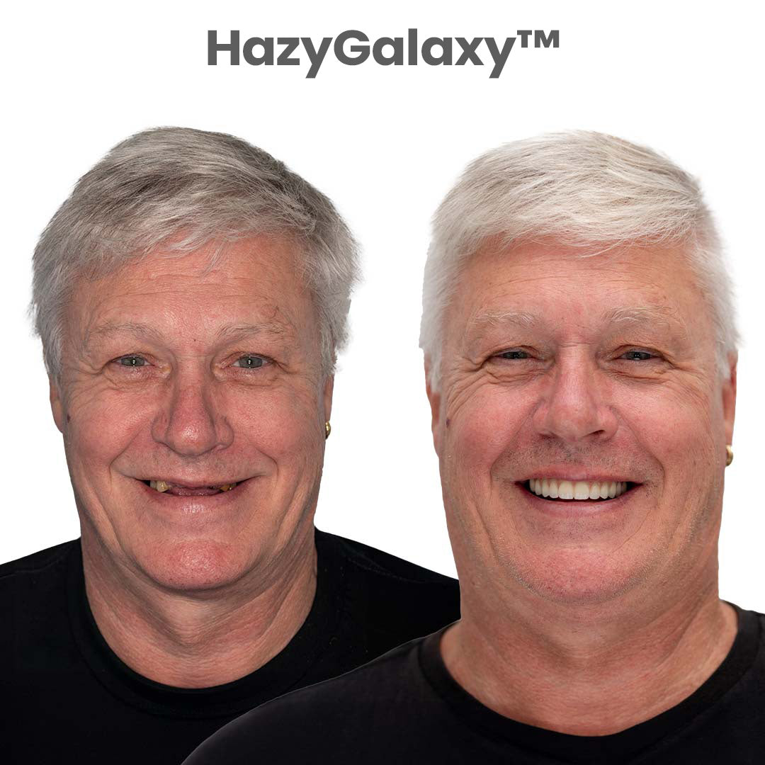 ✨ ENDS TODAY 80% OFF🔥 HazyGalaxy™ Custom-Fit Dentures 🦷Smile with Confidence